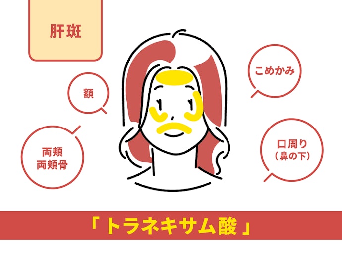 肝斑に悩む30~40代女性には、「トラネキサム酸」入りの飲み薬がおすすめ