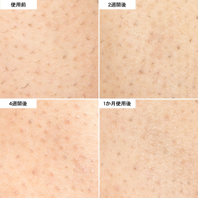 家庭用脱毛器ケノンの「買わなきゃよかった」という口コミは本当？実際