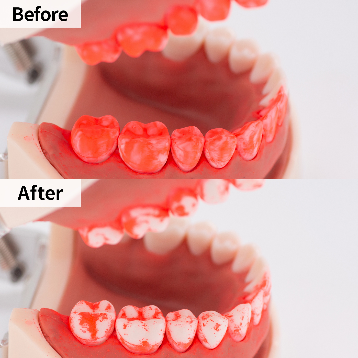 エミデント 超音波歯ブラシ スターターセットをレビュー！クチコミ