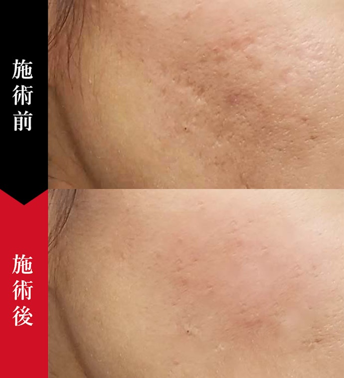開き毛穴と同時に肌質やハリの改善もしたい人は、ダーマペンをチョイス