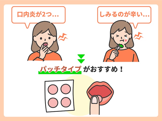 パッチタイプ:口内炎の数が2〜3個・しみる痛みを軽減させたい人に