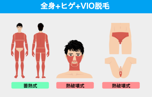 ④全身+ヒゲ+VIO脱毛