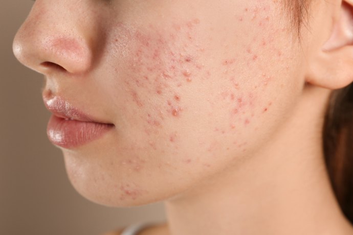 ベタつきやすい脂性肌・ニキビができやすい肌なら、皮脂吸着+抗炎症有効成分に注目