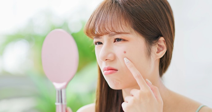 ストレスからくる気の乱れによるニキビなら、「半夏厚朴湯」「抑肝散」「桂枝加竜骨牡蛎湯」にも注目