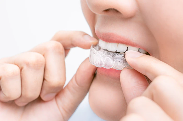 ホームホワイトニングの効果は何日で現れる?色戻りするまでの期間や持続させるコツも解説